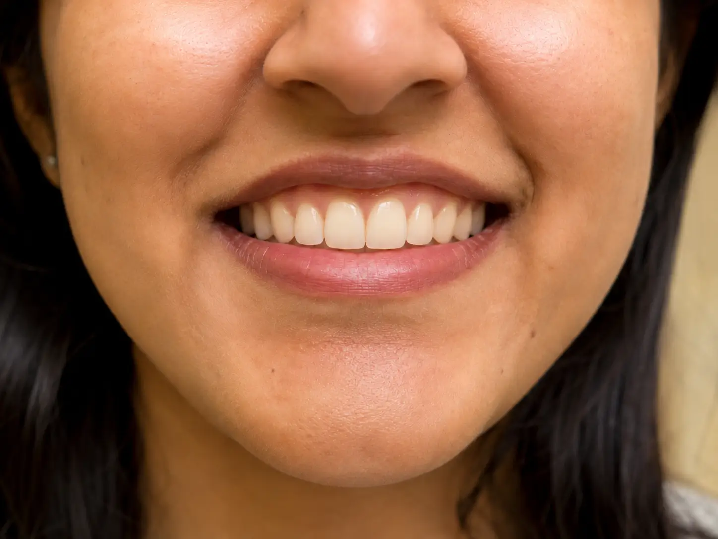 Overbite after Invisalign treatment